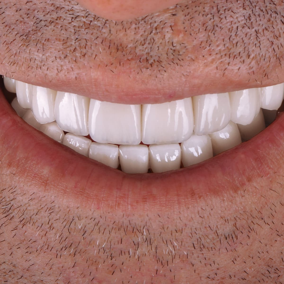 Hollywood Smile (Smile Design) Dental Care